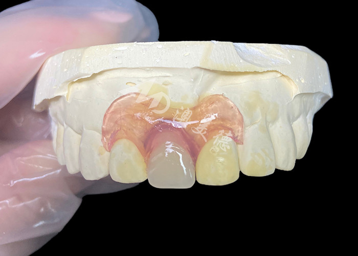 Prótese parcial flexible de Nesbit para incisivos que ofrece una solución de reemplazo de dientes extraíbles sin costuras