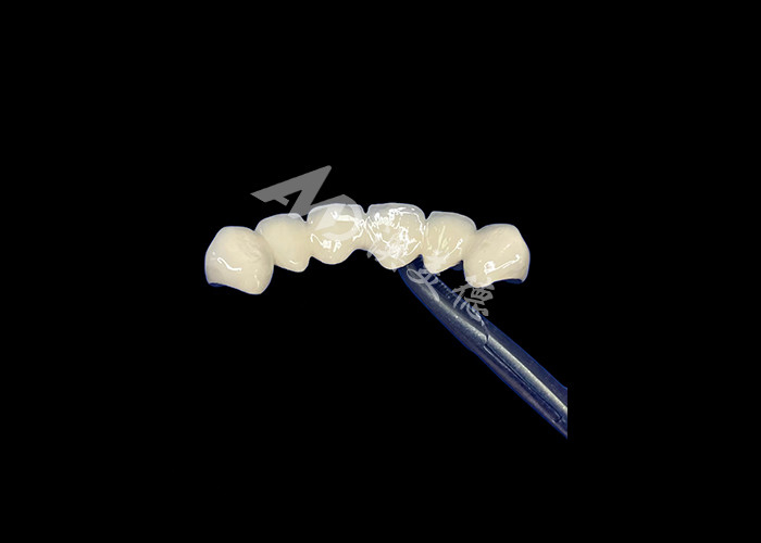 Porcelana biocompatible fusionada con corona de metal de alta durabilidad para una mejor restauración