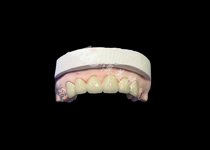 Porcelana biocompatible fusionada con corona de metal de alta durabilidad para una mejor restauración