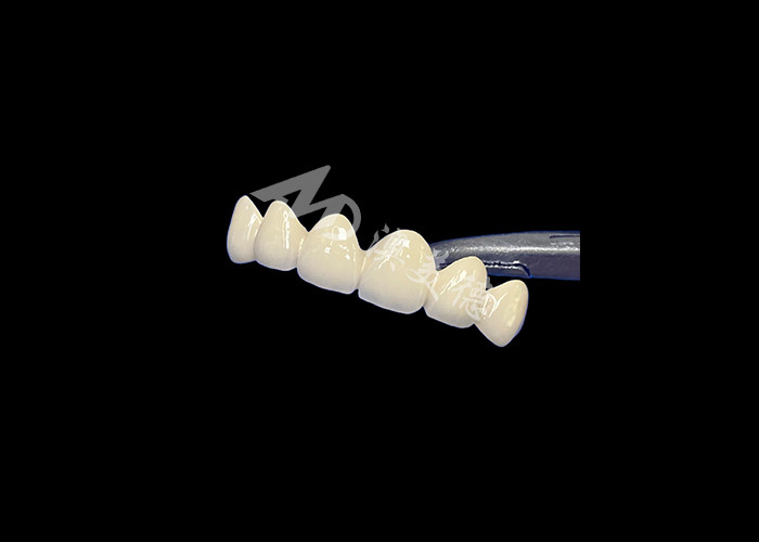 Porcelana biocompatible fusionada con corona de metal de alta durabilidad para una mejor restauración