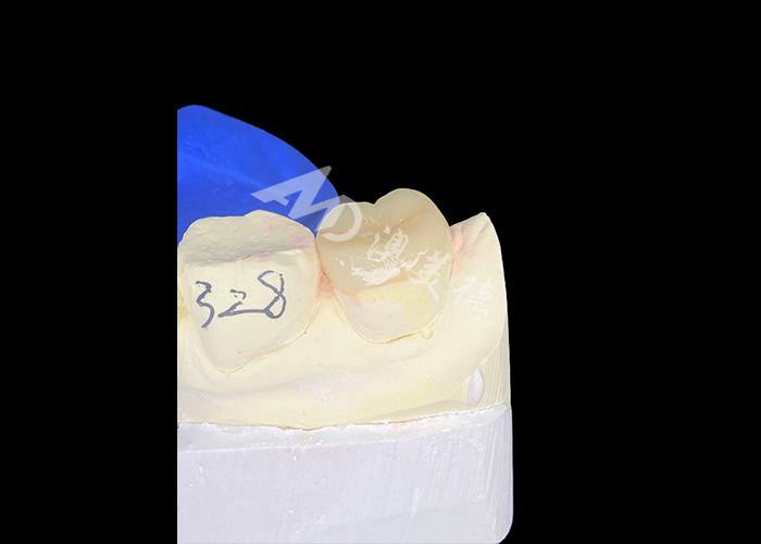 IPS E.max incrustaciones cerámicas incrustaciones sin costuras mezcla de aspecto natural y duradero con sus dientes