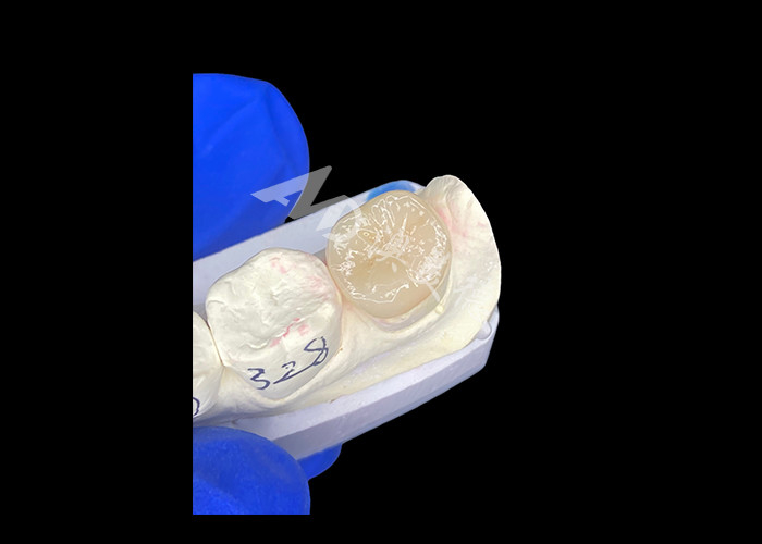IPS E.max incrustaciones cerámicas incrustaciones sin costuras mezcla de aspecto natural y duradero con sus dientes