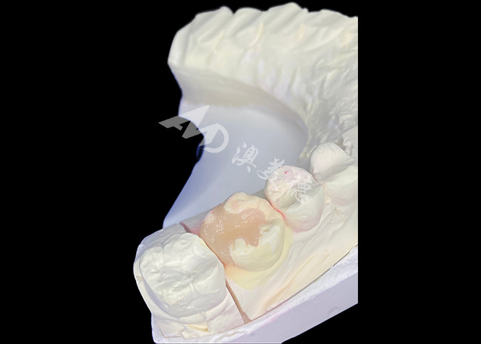 IPS e.max Inlays y Onlays cerámicos para la restauración molar con resultados estéticos y naturales duraderos