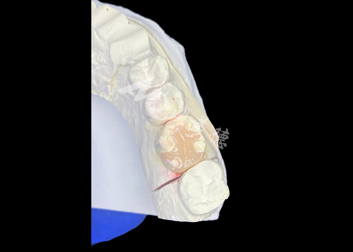 IPS e.max Inlays y Onlays cerámicos para la restauración molar con resultados estéticos y naturales duraderos