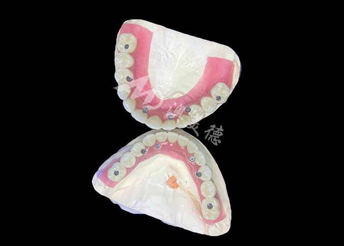 Dentistas con implantes dentales All-on-6 con estabilidad y comodidad