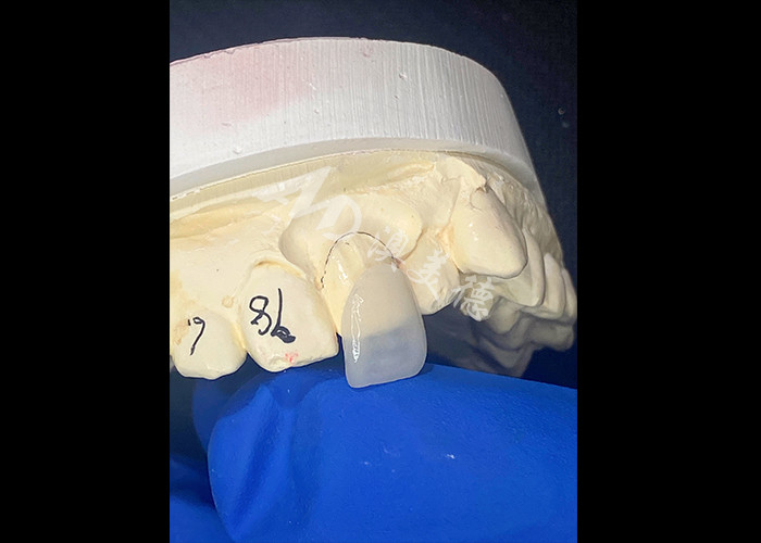 IPS e.max Carillas para incisores en tono A1 Estética natural para sonrisas impecables