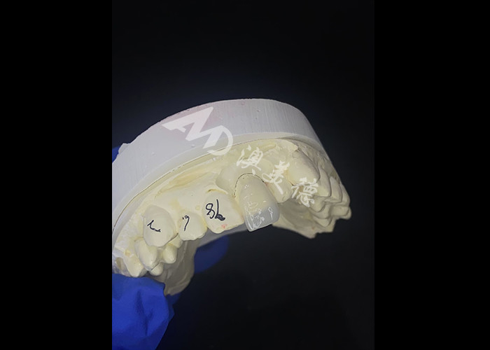 IPS e.max Carillas para incisores en tono A1 Estética natural para sonrisas impecables