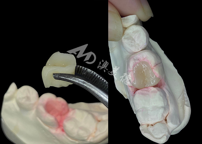 IPS e.max Intracciones y onlays cerámicas para la restauración dental de aspecto natural