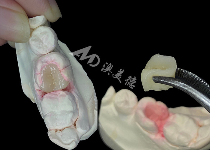 IPS e.max Intracciones y onlays cerámicas para la restauración dental de aspecto natural