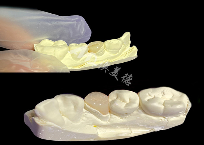 IPS e.max Intracciones y onlays cerámicas para la restauración dental de aspecto natural