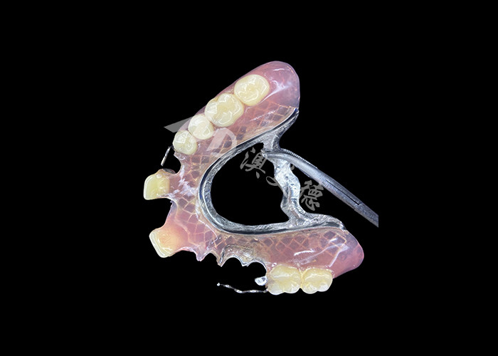Dentaduras parciales fundidas para una durabilidad y comodidad de precisión en el reemplazo parcial de dientes