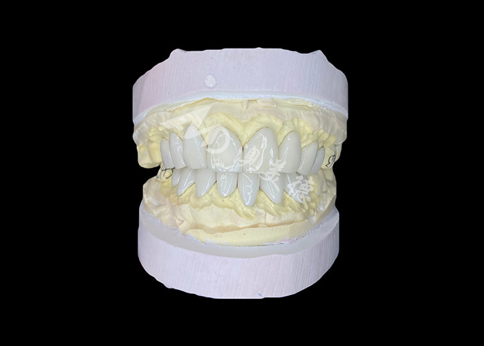 Carillas IPS e.max de precisión para transformaciones de sonrisa sin rival que ofrecen una estética de durabilidad excepcional