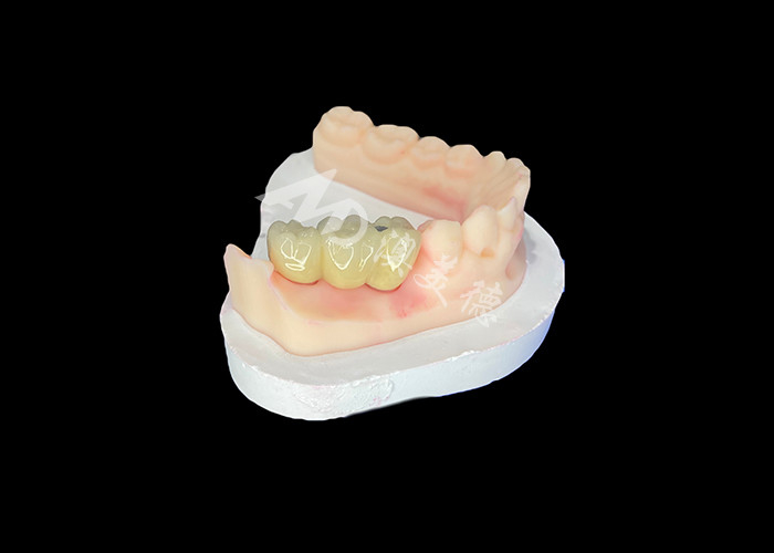 Coroas dentales PFM reales y resistentes a la corrosión para una salud oral óptima