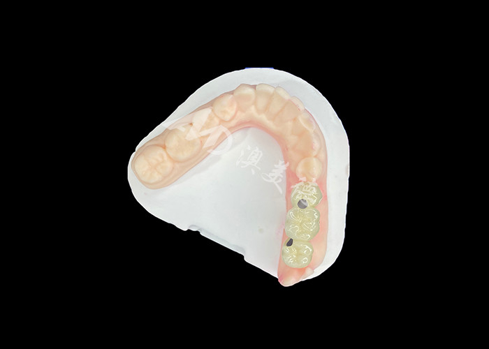 Coroas dentales PFM reales y resistentes a la corrosión para una salud oral óptima