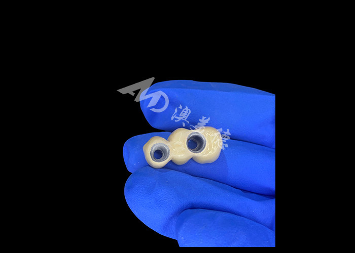Coroas dentales PFM reales y resistentes a la corrosión para una salud oral óptima