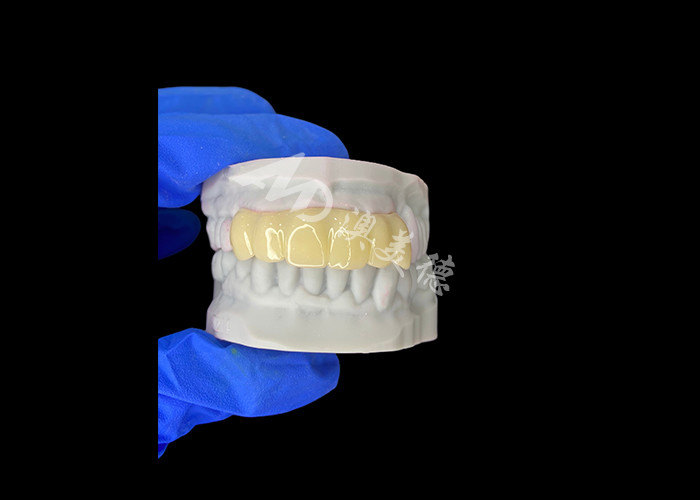 Puente temporal hueco de impresión 3D biocompatible ligero para restauraciones previas al implante