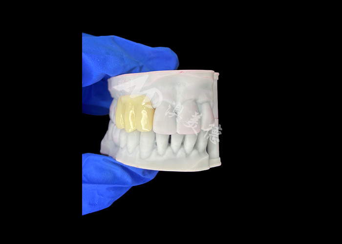 Puente temporal hueco de impresión 3D biocompatible ligero para restauraciones previas al implante