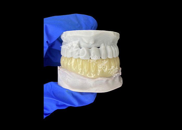 Puente temporal hueco de impresión 3D biocompatible ligero para restauraciones previas al implante