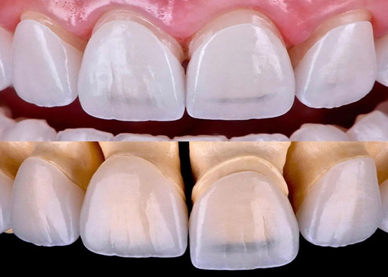 Buen precio Venecedor dental EMAX de larga duración fabricado con material cerámico de zirconio en línea