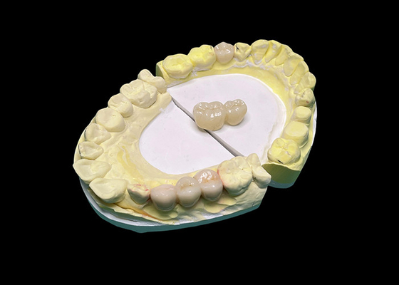 Buen precio Coronas y puentes de cerámica de translucidez avanzada mejoran su sonrisa con precisión y estética natural para una durabilidad duradera en línea