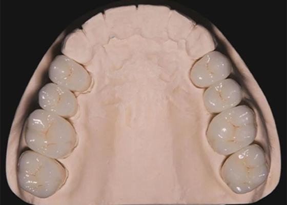 Buen precio Restauración dental Dientes Zirconia coronas dentales hechas por laboratorio dental de China en línea