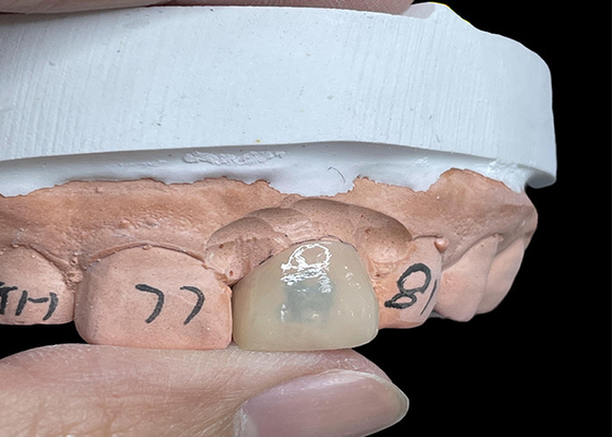 Buen precio Las carillas EMAX transforman su sonrisa con dientes de aspecto natural altamente translúcidos en línea