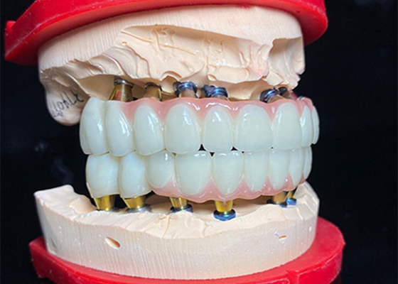 Buen precio Implante dental de base de titanio pulido Puente de corona de cerámica para restauración dental en línea