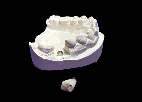 Buen precio Implante dental con corona de cerámica y abutment de titanio para molar en línea