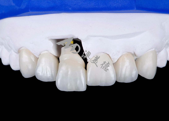 Buen precio Corona de implantes dentales de titanio para sonrisas de aspecto natural en línea