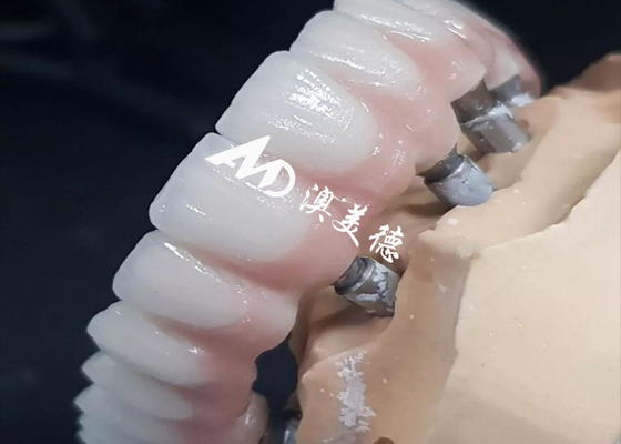 Buen precio Implante dental exclusivo de alto rendimiento Puente de corona de varios tamaños disponibles en línea