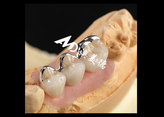 Buen precio Porcelana PFM fuerte fusionada con corona de metal excelente biocompatibilidad resistencia al desgaste en línea