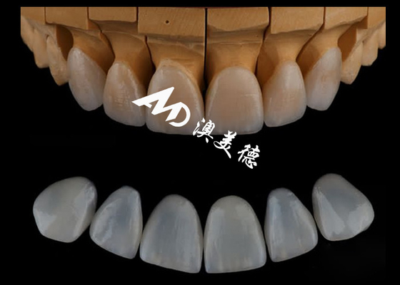 Buen precio Carillas dentarias de Emax/porcelana personalizadas de alta precisión para odontología cosmética en línea