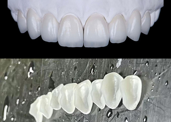 Buen precio IPS emax Las carillas de porcelana de prensa logran una sonrisa natural y radiante en línea