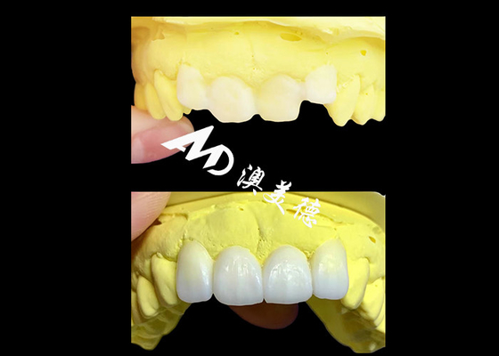 Buen precio Coronas dentales de zirconia translúcidas hechas a medida por AMD Dental Lab en línea