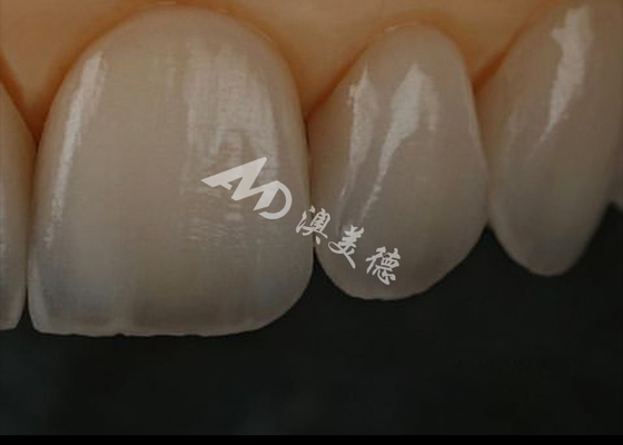 Buen precio Resistencia a las astillas Corona dental de zirconia para dientes anteriores / posteriores en línea