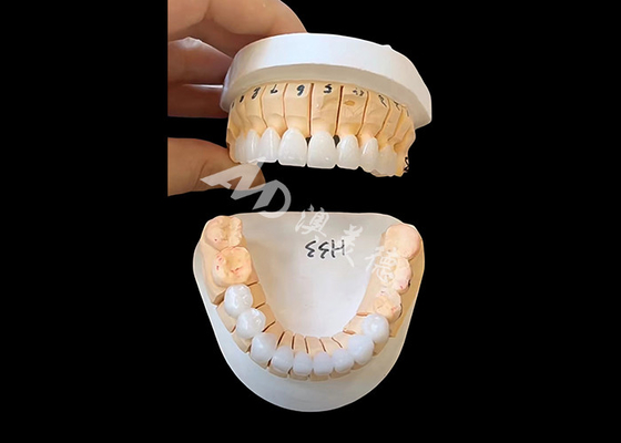 Buen precio Corona dental de zirconia de translucidez mejorada para restauraciones fijas de unidad única o múltiple en línea