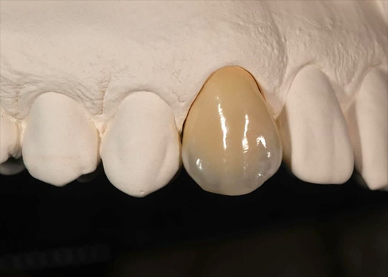 Buen precio Resistencia a la mancha Corona de zirconia sólida para dientes delanteros dientes posteriores en línea