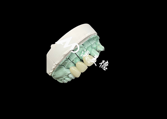 Buen precio Corona de cerámica de Emax Solución personalizable y asequible para la restauración dental en línea