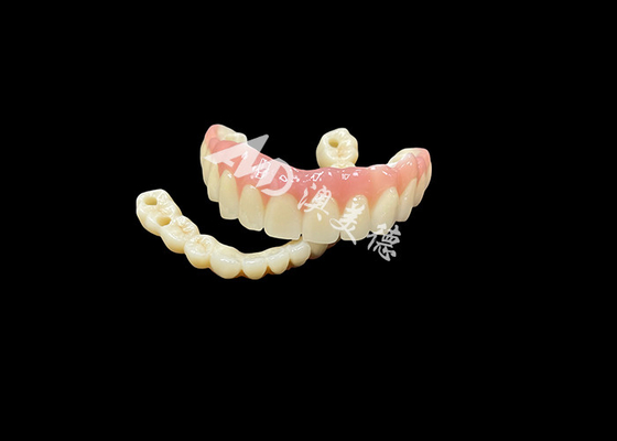 Buen precio Las prótesis dentarias con implantes Puente La solución dental definitiva para los dientes perdidos en línea