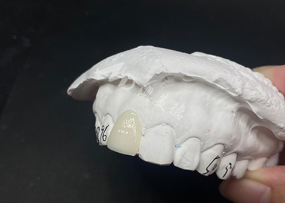 Buen precio Carillas dentales translúcidas personalizadas Soluciones rápidas y eficaces para una sonrisa duradera en línea