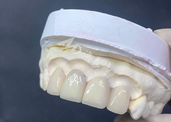 Buen precio Carillas dentales de precisión, de excelente ajuste y alta translucidez para una sonrisa impecable en línea