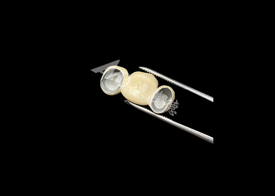 Buen precio Porcelana de ajuste preciso fundida a corona de metal con excelente biocompatibilidad en línea