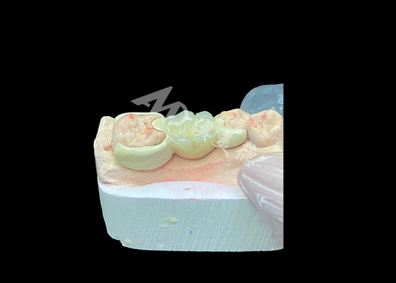 Buen precio Corona de zirconio con puente de unión HPP para mejorar la estética de la sonrisa y la biocompatibilidad en línea