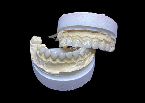 Buen precio Personalización Veneces de vidrio ultra delgado cerámicas de alta translucidez en línea