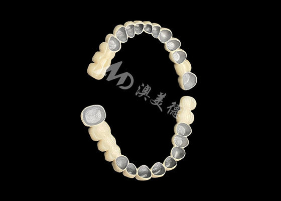 Buen precio Porcelana personalizada fusionada con puente de corona dental de metal para mejorar la sonrisa natural en línea