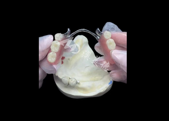 Buen precio Porcelana duradera fundida a la corona dental de metal PFM corona para la restauración en línea