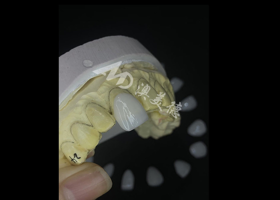 Buen precio Carillas IPS e.max de precisión para transformaciones de sonrisa sin rival que ofrecen una estética de durabilidad excepcional en línea