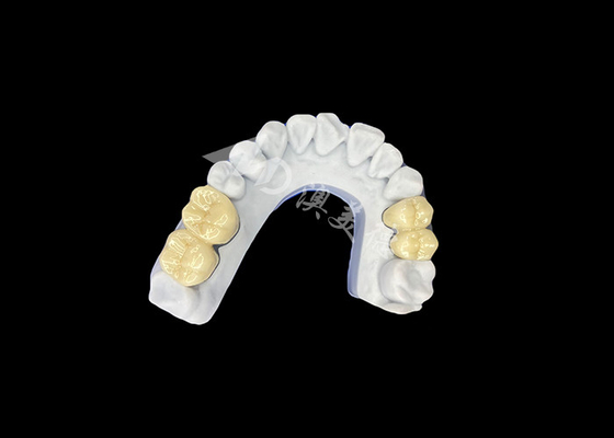 Buen precio Coroa dental de porcelana de zirconia PFZ del laboratorio dental profesional de China en línea