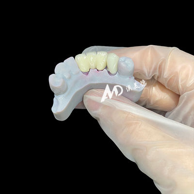 Buen precio Corona dental de zirconio con núcleo de post de metal que ofrece una estética de aspecto natural, una adaptación precisa y una biocompatibilidad superior en línea