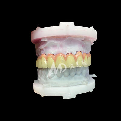 Buen precio Corona y puente de cerámica de titanio puro Restauración estética ligera y duradera en línea